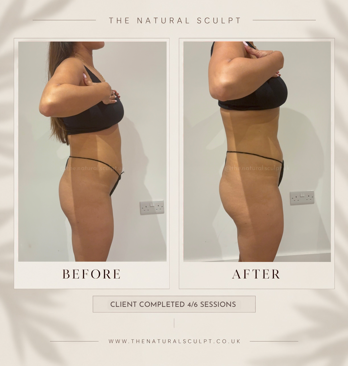 Before and after body sculpting at The Natural Sculpt, London